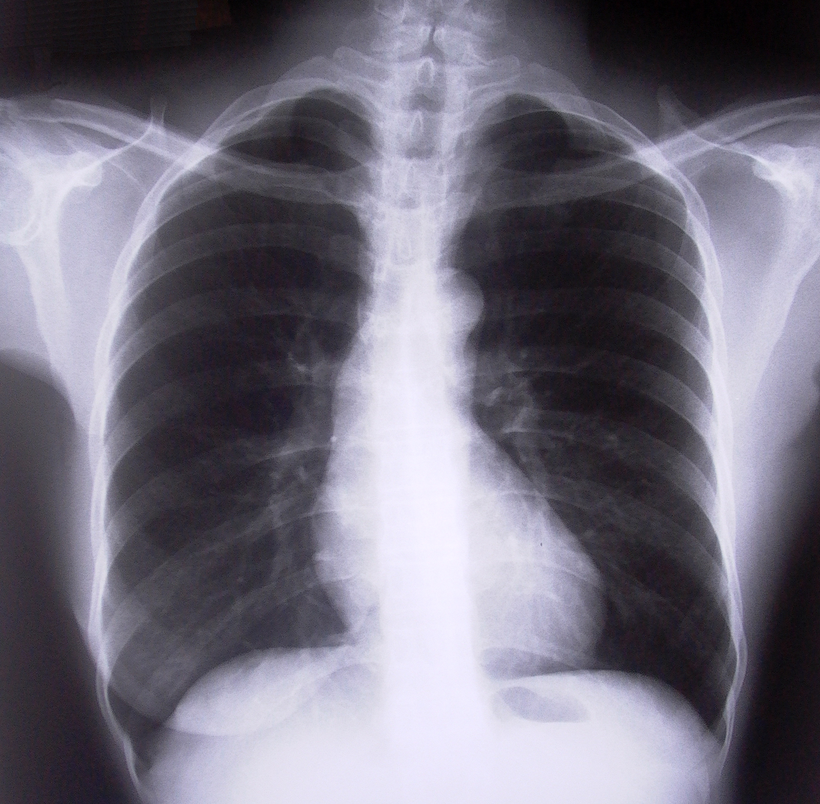 Снимок. Флюорография грудной клетки пневмония. Флюорография ОГК плеврит. Лёгкие рентген. Снимок здоровых легких.